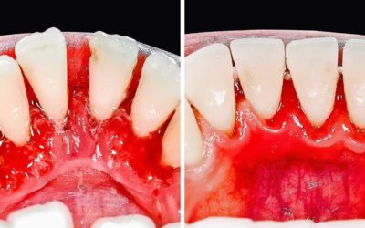 30 СУПЕР-ЛАЙФХАКОВ ПО УХОДУ ЗА ЗУБАМИ