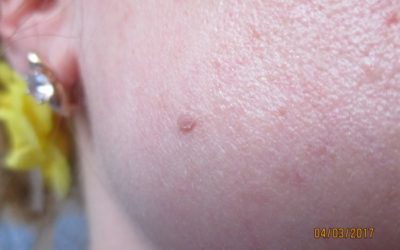 Удаление бородавки на лице в домашних условиях с помощью «Супер Чистотело»